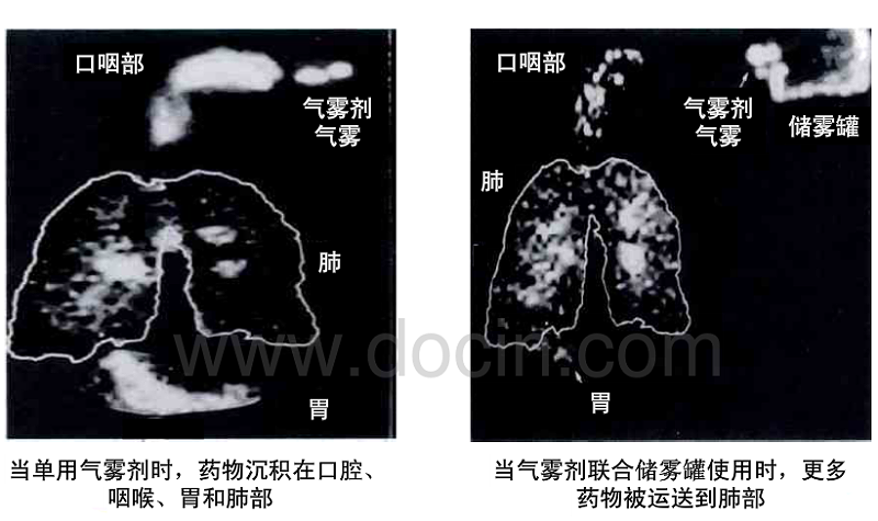 氣霧劑結(jié)合氣霧罐使用時治療效果更佳